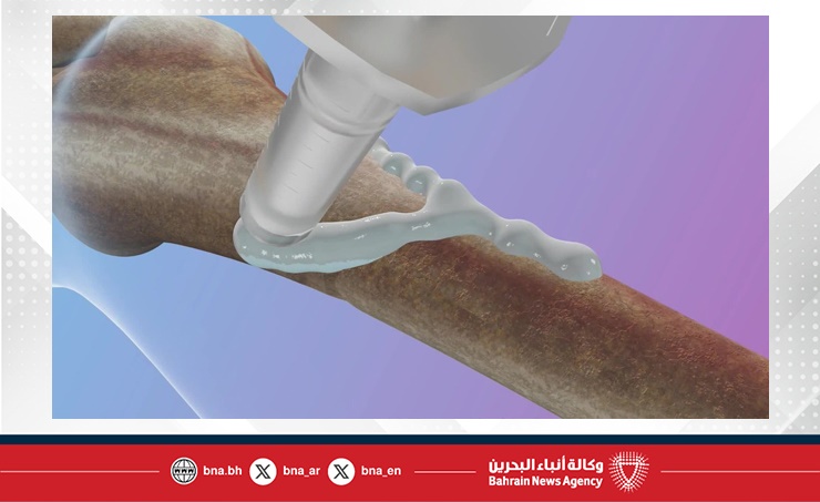 علماء صينيون يطورون "غراءا عظميا" يصلح الكسور خلال 3 دقائق فقط