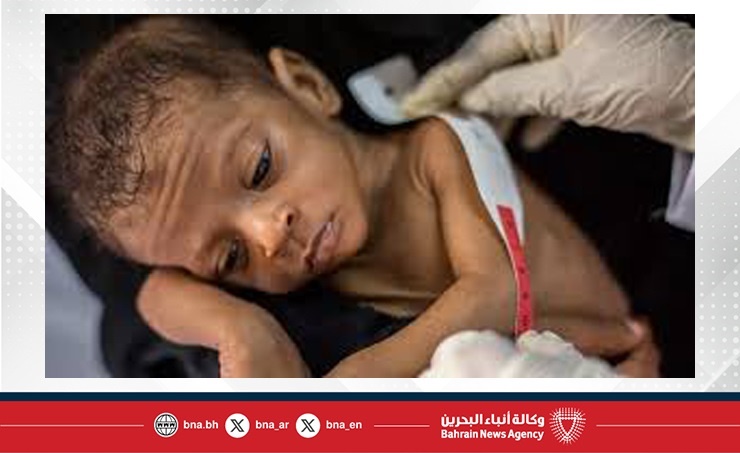 سوء التغذية يودي بحياة مئات الأطفال في جنوب أفريقيا خلال 18 شهرًا